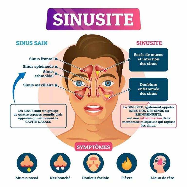 La sinusite ⁉️...