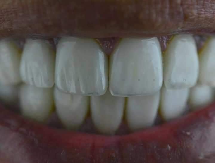 Life changing job was done here!A male patient in his 30's that had NEVER used a tooth brush! and a heavy smoker.2 months of oral hygiene education and follow up's to establish healthy habits and adequate oral hygiene level to commence the treatment.preparation and cementation of Lithium 20 Disilicate veneers, shade BL3.Cementation using RelyX veneer BL shade.